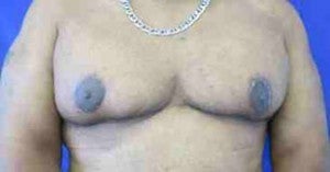 Male Breast Reduction after 3099955