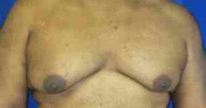 Male Breast Reduction before 3099955