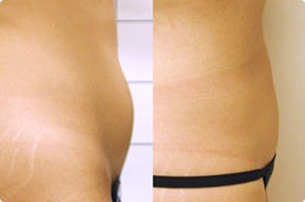 Smart Lipo: Abdomen before 989032