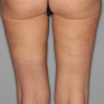 45-54 year old woman treated with Cellfina after 3645677