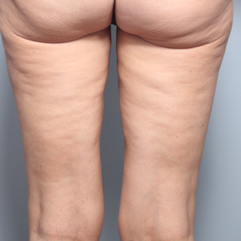 45-54 year old woman treated with Cellfina before 3645677
