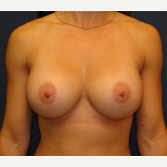 35-44 year old woman treated with Breast Augmentation after 3241293