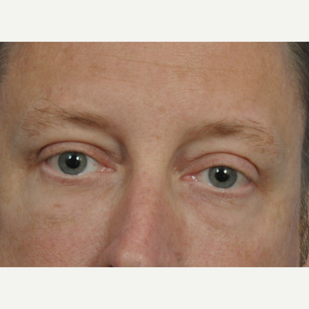 45-54 year old man treated with Eye Bags Treatment after 2833669
