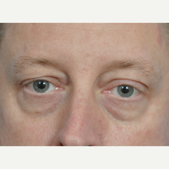 45-54 year old man treated with Eye Bags Treatment before 2833669