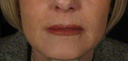 45-54 year old woman treated with Halo Laser after 2285322