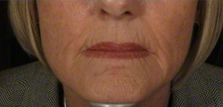 45-54 year old woman treated with Halo Laser before 2285322