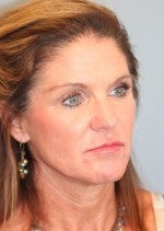 55-64 year old woman treated with Neck Lift before 3103878