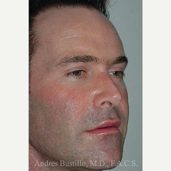 25 year old man treated with Revision Rhinoplasty after 3460634