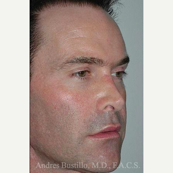 25 year old man treated with Revision Rhinoplasty before 3460634
