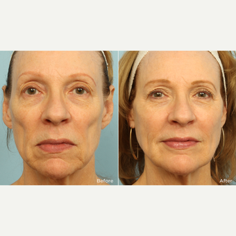 55-64 year old woman treated with Voluma before 3220094