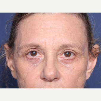 65-74 year old woman treated with Eyelid Surgery (view 1 of 2) after 3181148