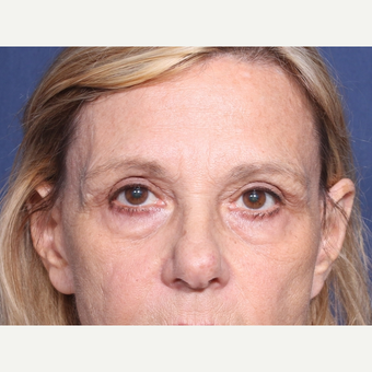 65-74 year old woman treated with Eyelid Surgery (view 1 of 2) before 3181148