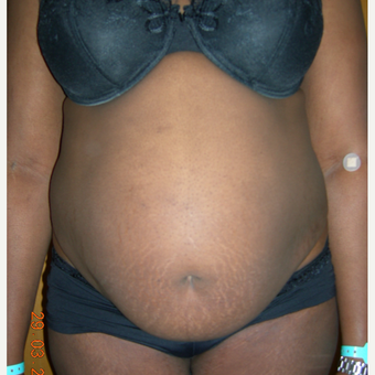 25-34 year old woman treated with Tummy Tuck before 3553991