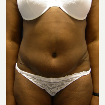 25-34 year old woman treated with Tummy Tuck after 3553991