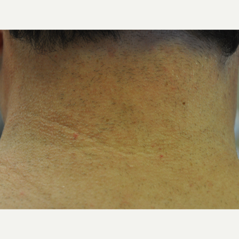 45-54 year old woman treated with Laser Hair Removal after 3219700