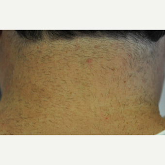 45-54 year old woman treated with Laser Hair Removal before 3219700