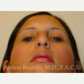 23 year old woman treated with Rhinoplasty before 3461020