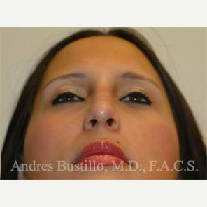 23 year old woman treated with Rhinoplasty after 3461020