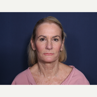 55-64 year old woman treated with Neck Lift (view 1 of 2) before 3175365
