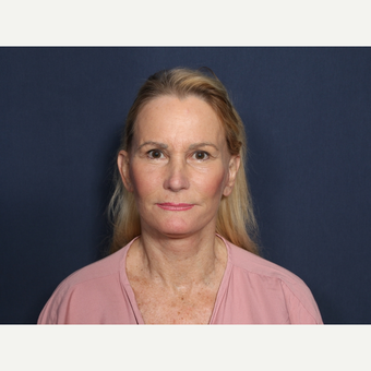 55-64 year old woman treated with Neck Lift (view 1 of 2) after 3175365
