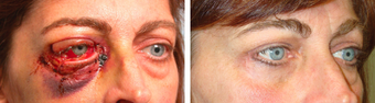 Orbital / Eyelid Trauma before 1188842