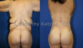 Torso Back Reduction before 660649