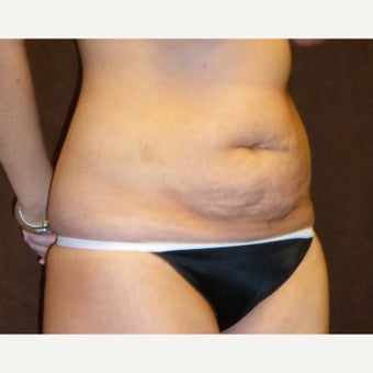 25-34 year old woman treated with Tummy Tuck before 2062554