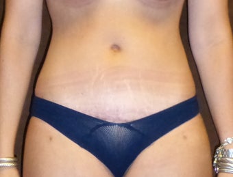 25-34 year old woman treated with Tummy Tuck 2062554