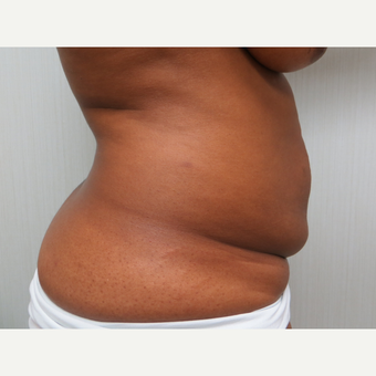 25-34 year old woman treated with Tummy Tuck before 3300068