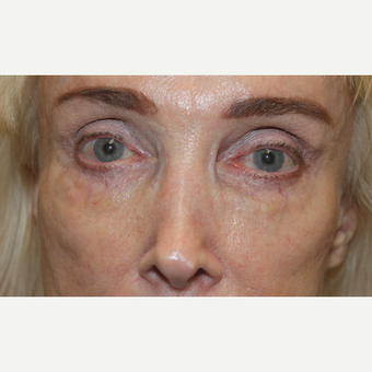 65-74 year old woman treated with Juvederm after 3241059
