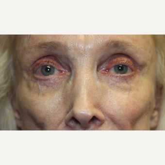 65-74 year old woman treated with Juvederm before 3241059