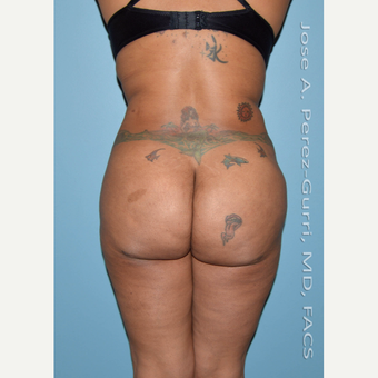 35-44 year old woman treated with Liposuction-Hips/flanks/abdomen-Power Assisted (PAL) before 3080036
