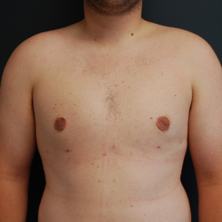 25-34 year old man treated with Male Breast Reduction after 3613616
