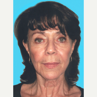 Facelift before 3826912