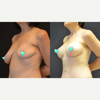 45-54 year old woman treated with Fat Transfer before 3703980