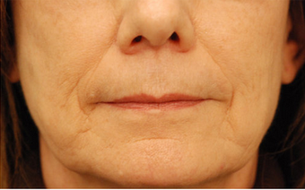 Restylane before 149887