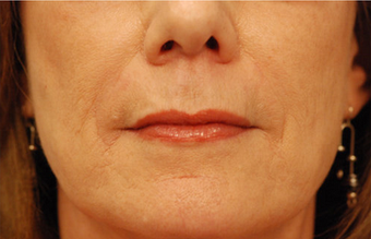 Restylane after 149887
