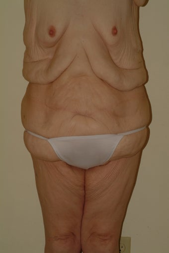 Tota body contouring before 1059173