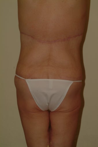 Tota body contouring 1059173