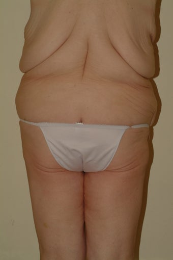 Tota body contouring 1059173