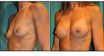 Tear Drop Breast Implants before 1017137