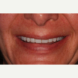 45-54 year old man treated with All-on-4 Dental Implants after 3093841
