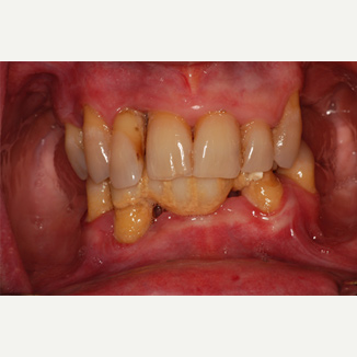 45-54 year old man treated with All-on-4 Dental Implants before 3093841