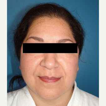 55-64 year old woman treated with MACS Facelift after 3748033
