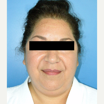 55-64 year old woman treated with MACS Facelift before 3748033