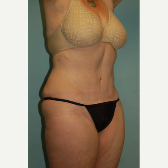58 year old woman, 5'6", 188 lbs. four months after lipoabdominoplasty after 3771642