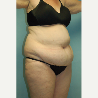 58 year old woman, 5'6", 188 lbs. four months after lipoabdominoplasty before 3771642