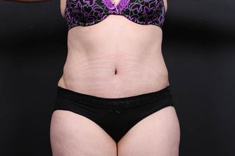 40 year old woman underwent full abdominoplasty with liposuction after 987584
