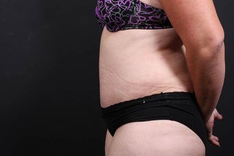 40 year old woman underwent full abdominoplasty with liposuction 987584