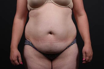 40 year old woman underwent full abdominoplasty with liposuction before 987584